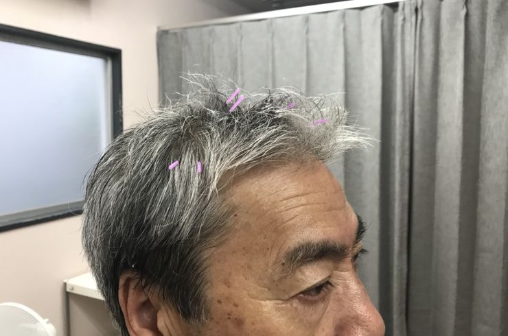頭部に鍼治療を受ける男性